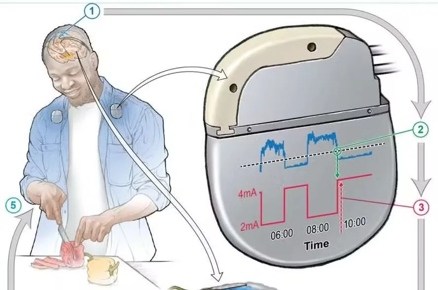 Marcapasso feito com IA que reduz em 50% os sintomas do Parkinson