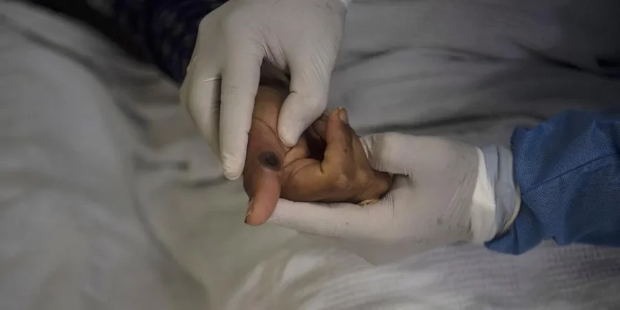 Ministério da Saúde intensifica enfrentamento à Mpox no Brasil