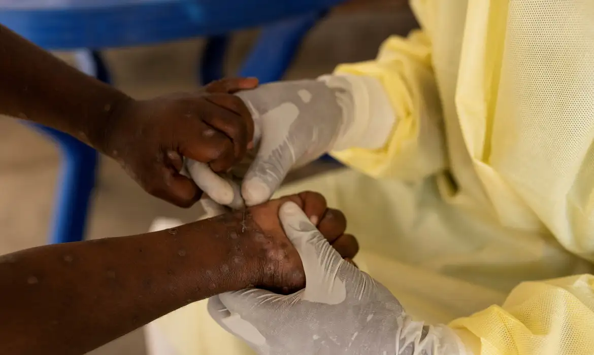  Brasil registra 88 casos de Mpox em 2026; maioria em SP