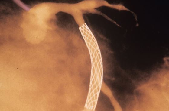 Stents não aliviam dor cardíaca, mostra estudo