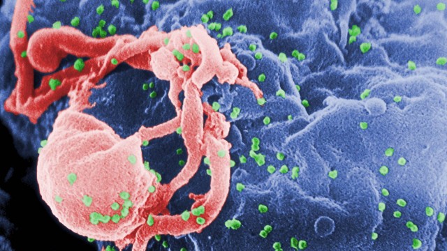 Infecção pelo HIV afeta desenvolvimento cerebral de crianças
